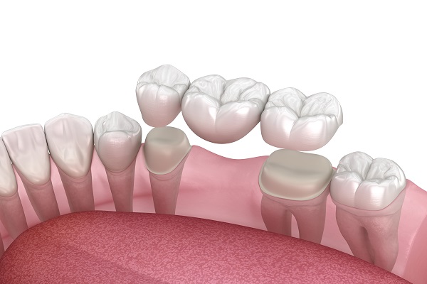 Is It Time For You To Get A Dental Bridge?