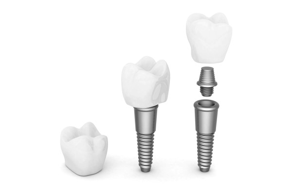 Visit A Prosthodontist For Tooth Replacement